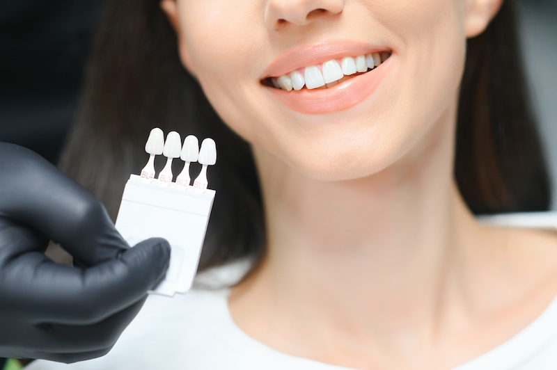 Are Veneers Reversible and What To Know