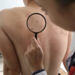 Understanding the Different Stages of Skin Cancer